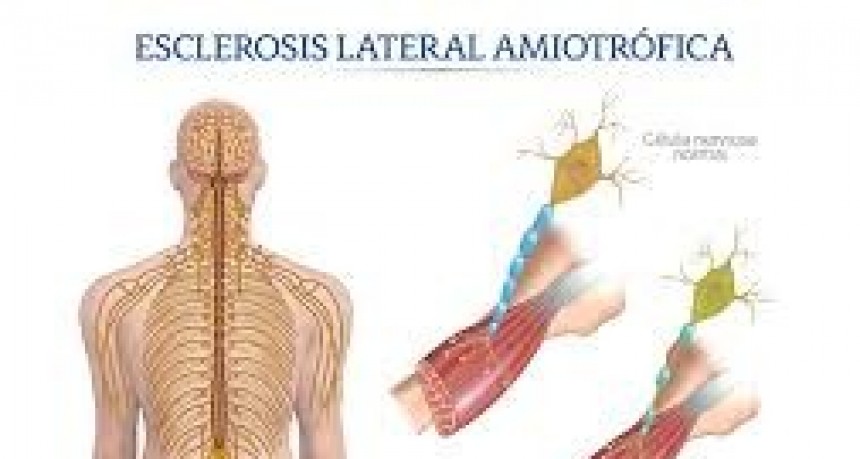Prevención esclerosis lateral amiotrófica